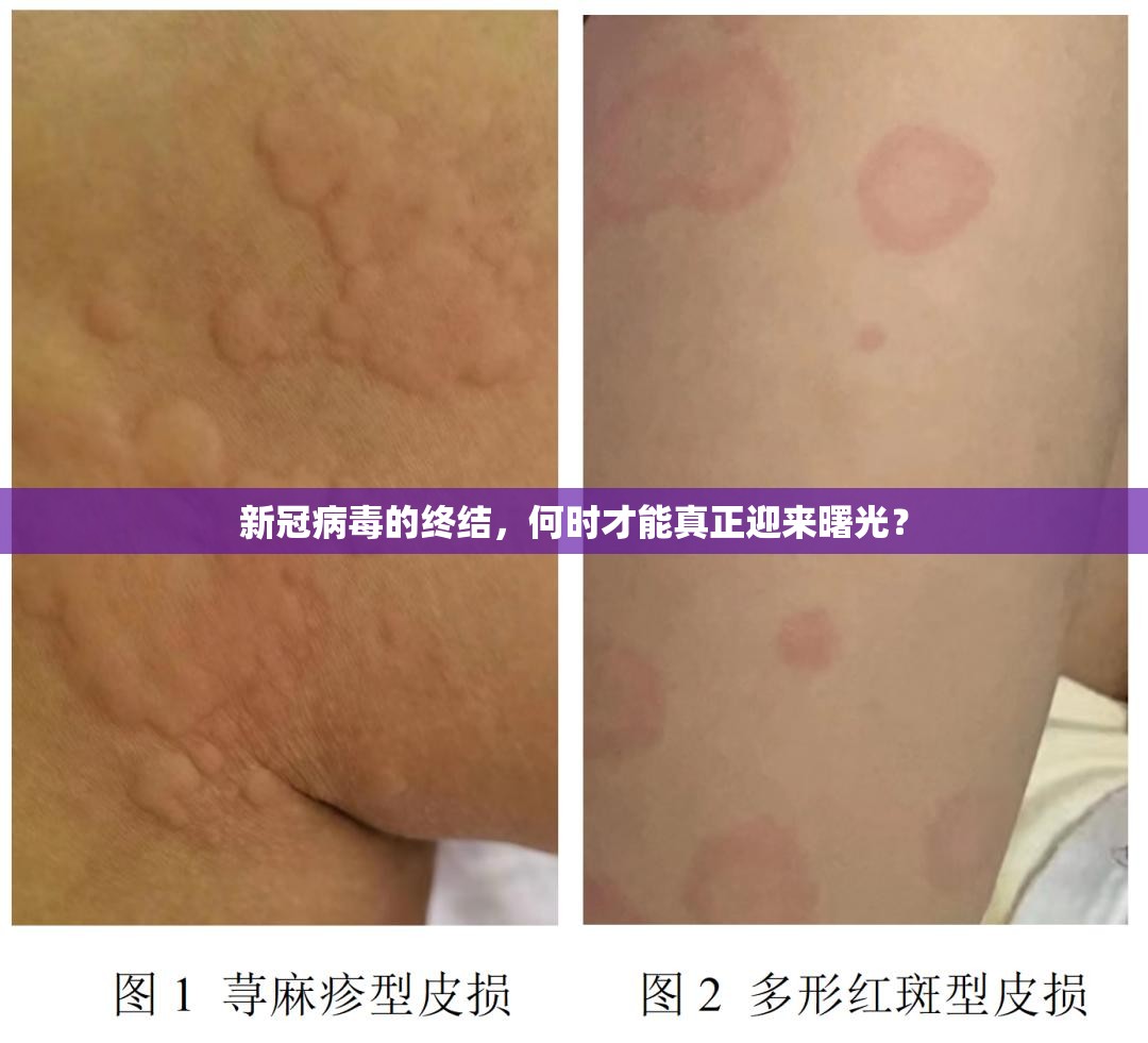 新冠病毒的终结，何时才能真正迎来曙光？