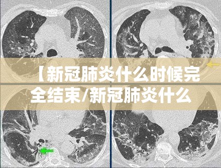 【新冠肺炎什么时候完全结束/新冠肺炎什么时候完全结束的】