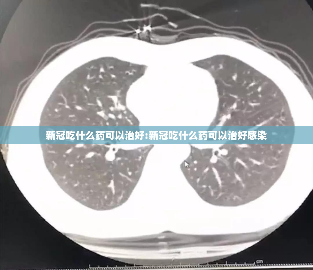新冠吃什么药可以治好:新冠吃什么药可以治好感染