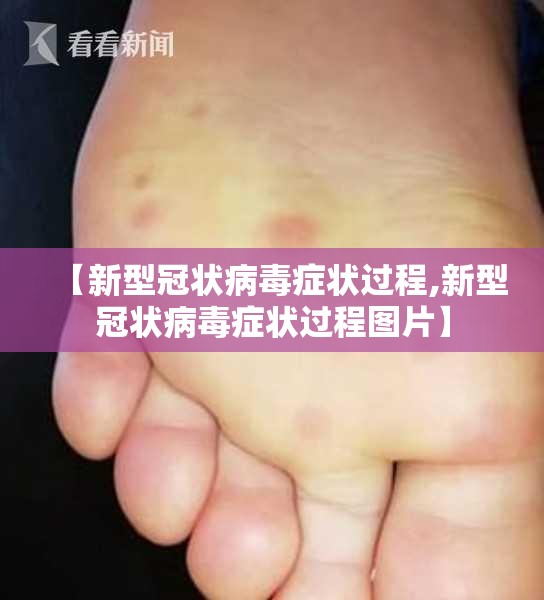 【新型冠状病毒症状过程,新型冠状病毒症状过程图片】