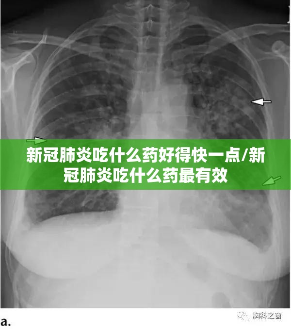 新冠肺炎吃什么药好得快一点/新冠肺炎吃什么药最有效