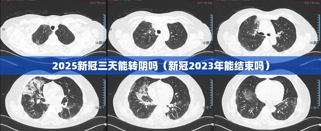2025新冠三天能转阴吗（新冠2023年能结束吗）