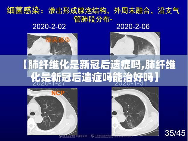 【肺纤维化是新冠后遗症吗,肺纤维化是新冠后遗症吗能治好吗】
