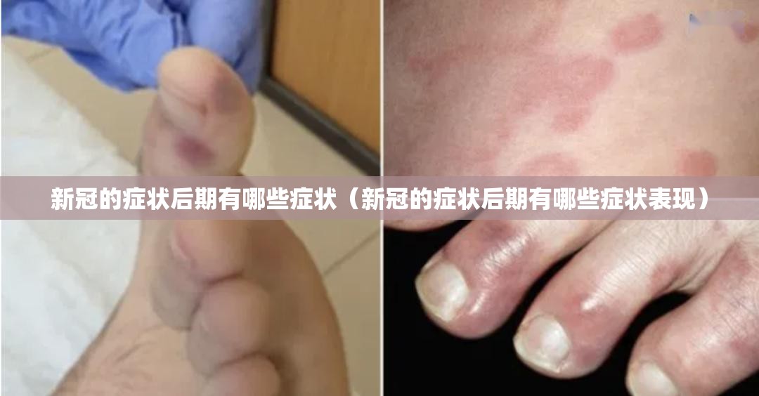 新冠的症状后期有哪些症状（新冠的症状后期有哪些症状表现）